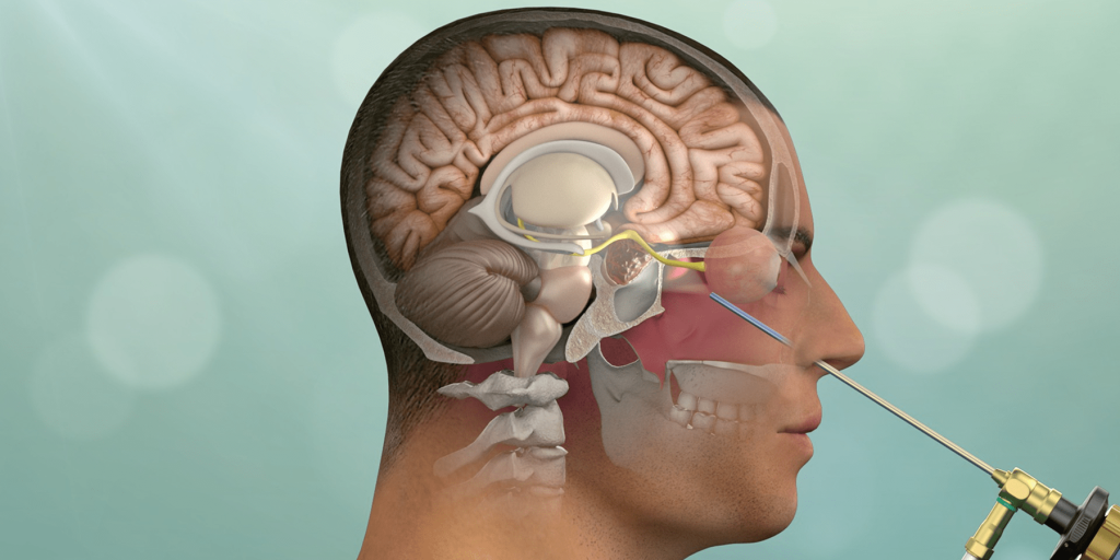 استئصال أورام الغدة النخامية بالمنظار