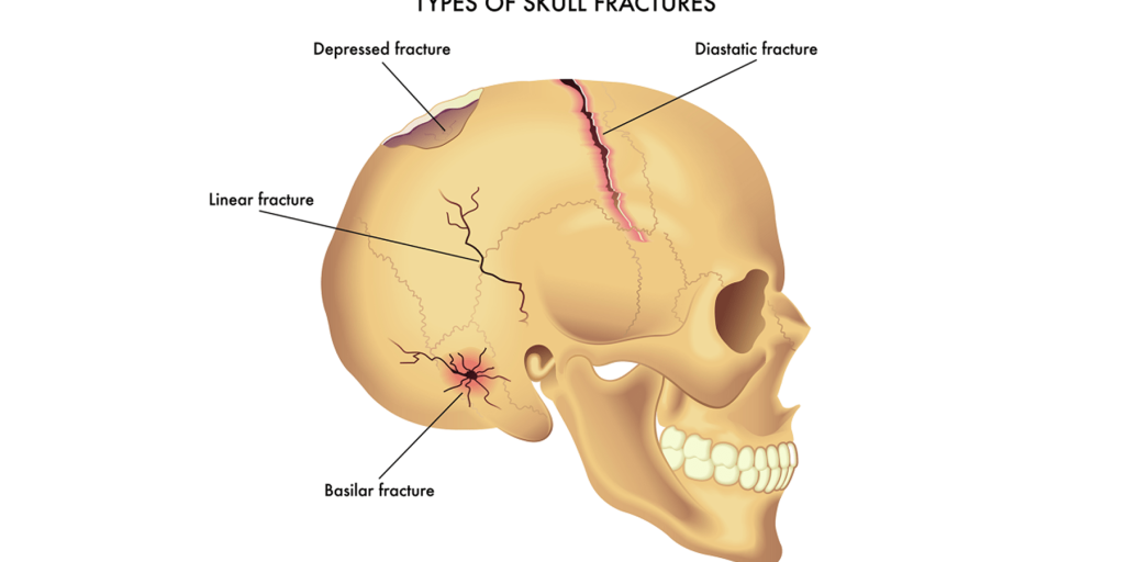 اصلاح كسور عظام الجمجمة
