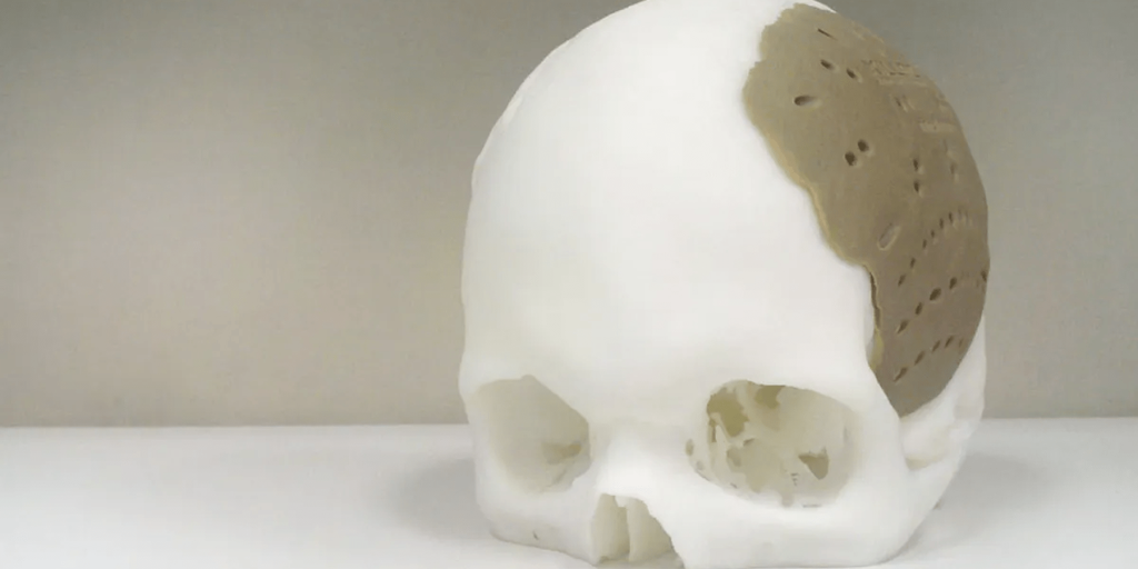 اصلاح عظام الجمجمة بتقنيات الطباعة ثلاثية الابعاد