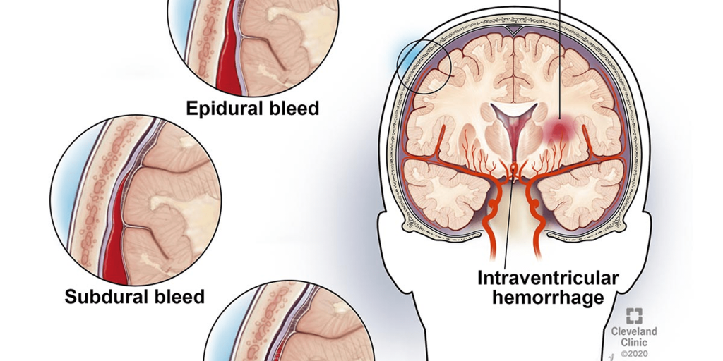 تفريغ الأنواع المختلفة من نزيف المخ