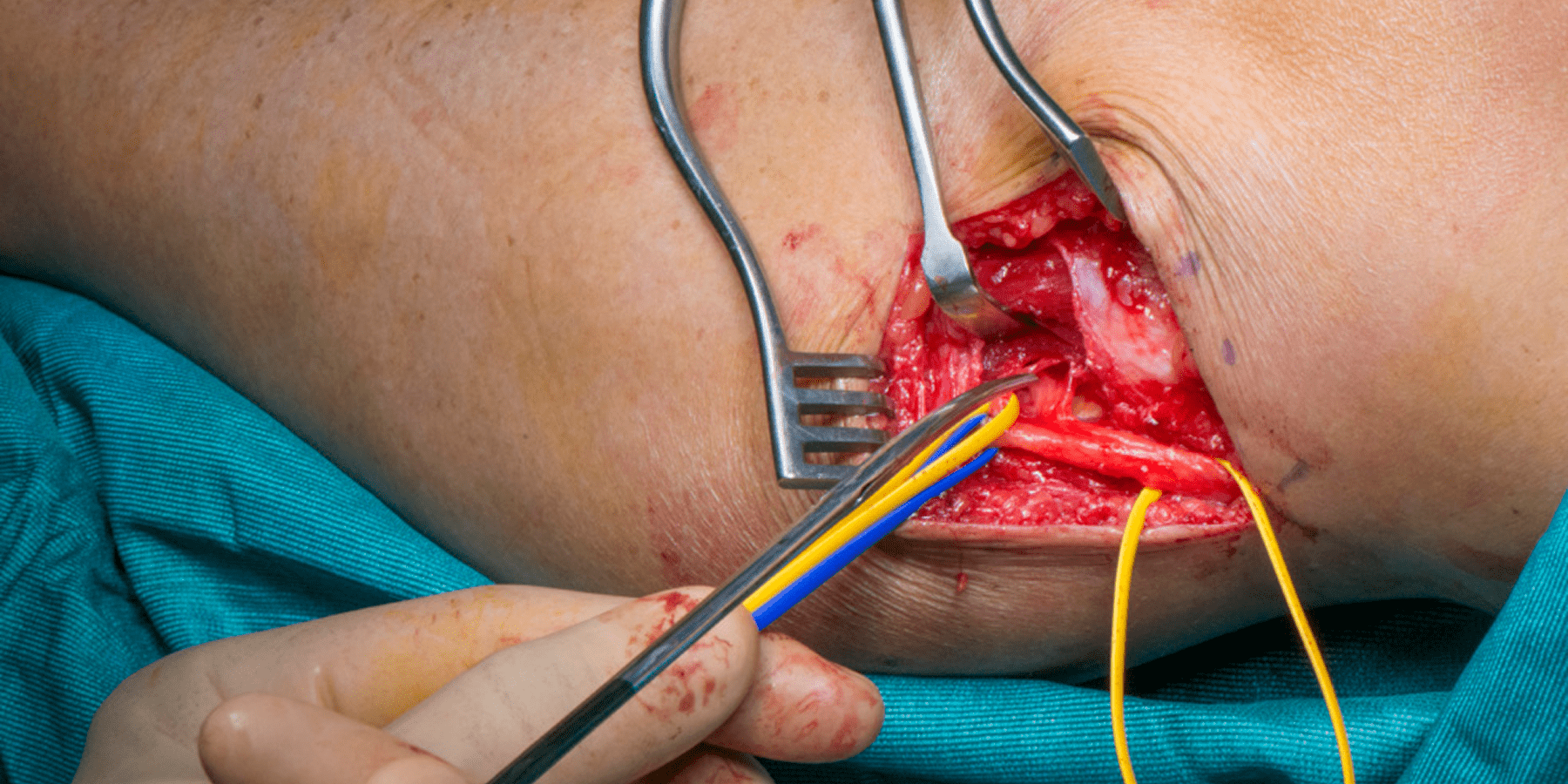 جراحات استكشاف الأعصاب بعد إصابات الاعصاب الطرفية