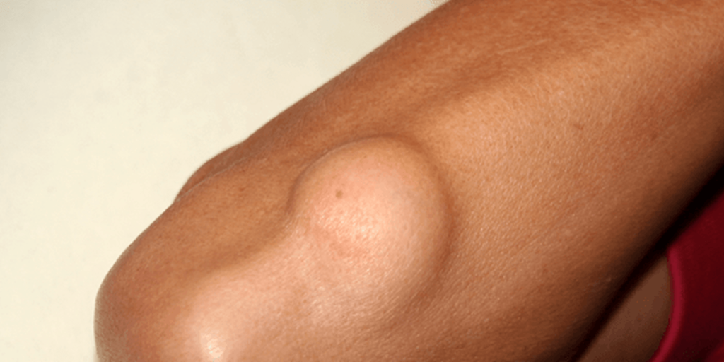 استئصال أورام الأعصاب الطرفية