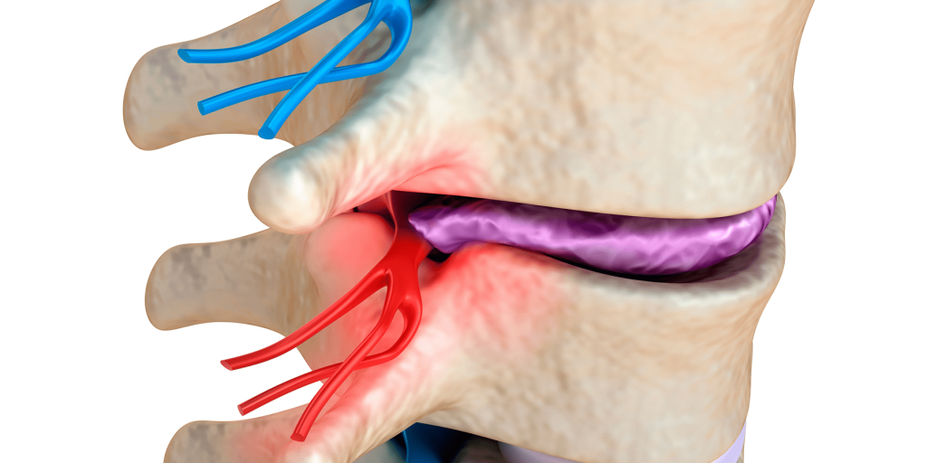 استئصال الانزلاق الغضروفي العنقي بالميكروسكوب