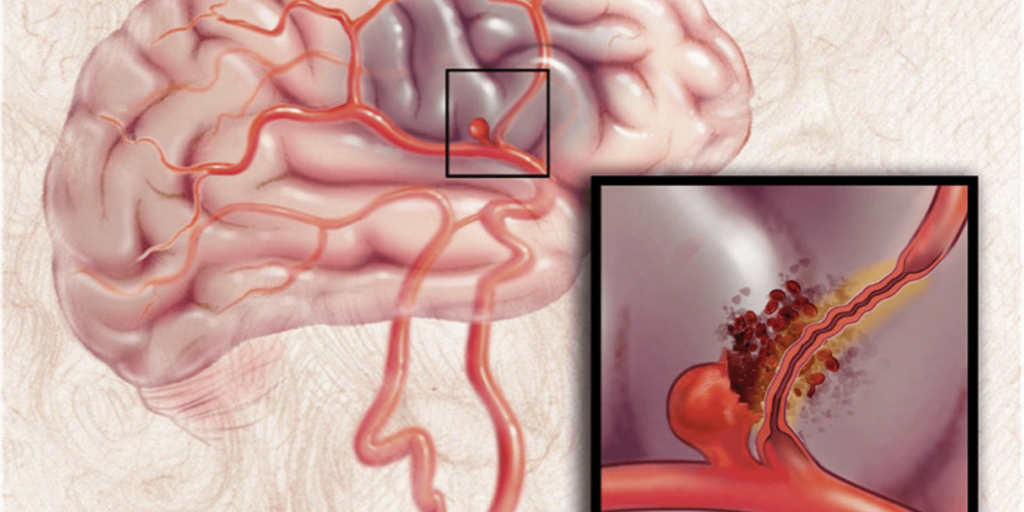 جراحات الأوعية الدموية بالمخ