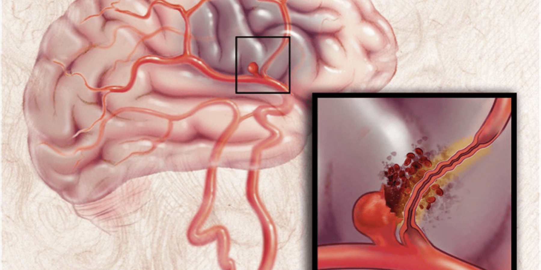جراحات الأوعية الدموية بالمخ