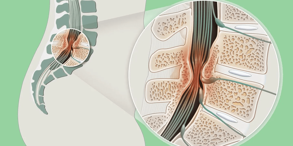 علاج ضيق القناة العصبية القطنية بالميكروسكوب والمنظار