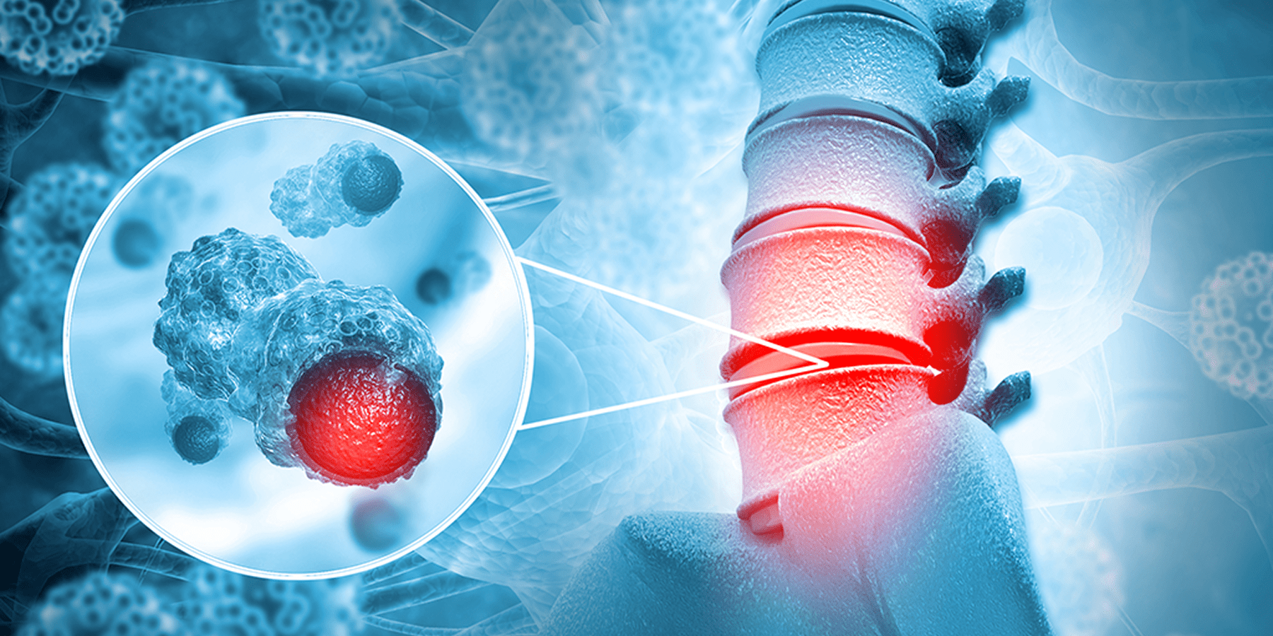 علاج أورام الحبل الشوكي والعمود الفقري