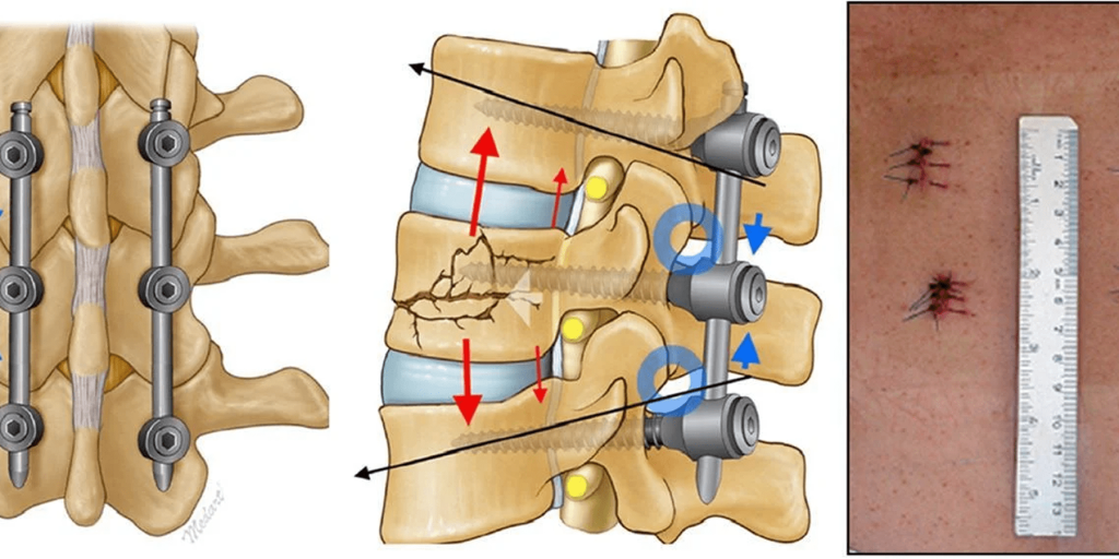 تثبيت الفقرات عن طريق الجلد