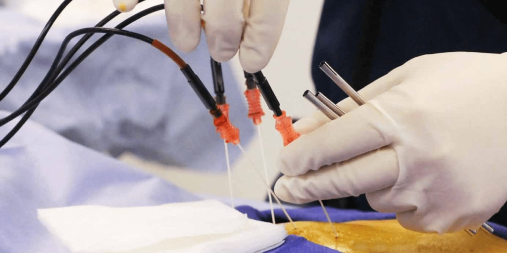 التدخل المحدود في مشكلات العمود الفقري حقن جذور الأعصاب والتردد الحراري