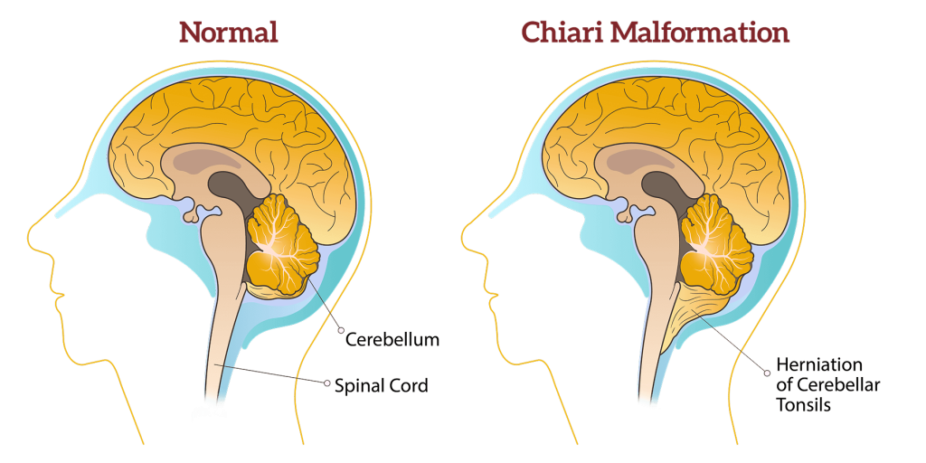 علاج حالات تشوه كياري – Chiari Malformation