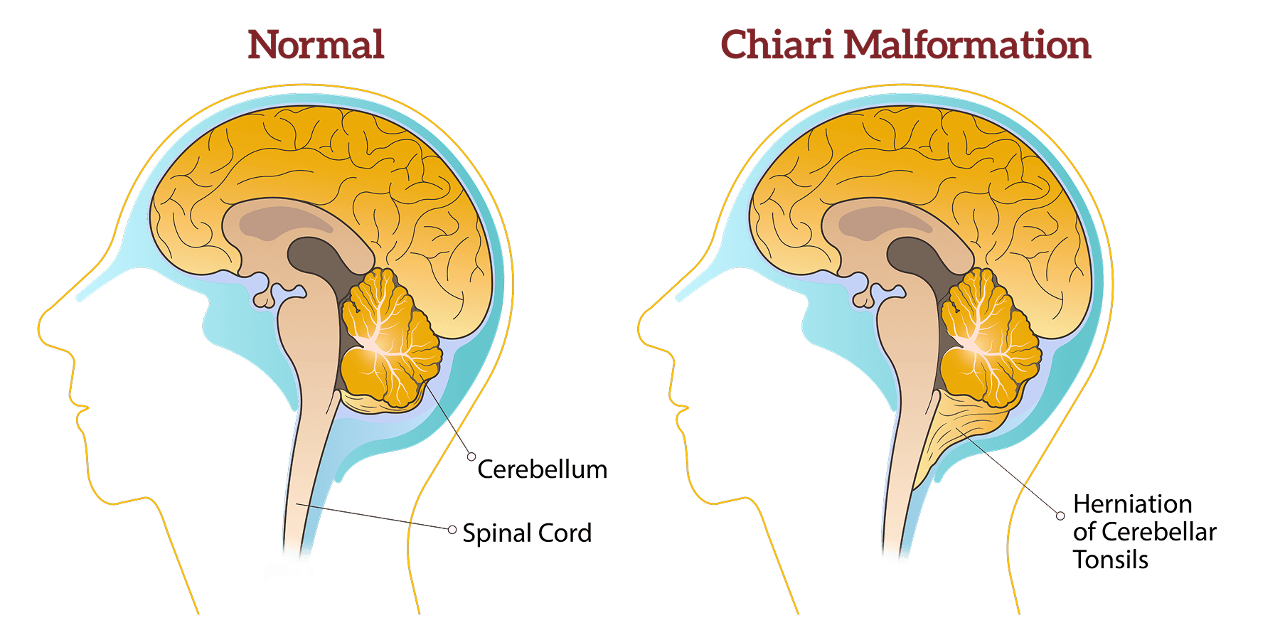 علاج حالات تشوه كياري – Chiari Malformation