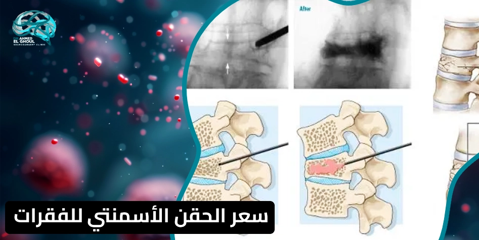 الحقن الأسمنتي للفقرات