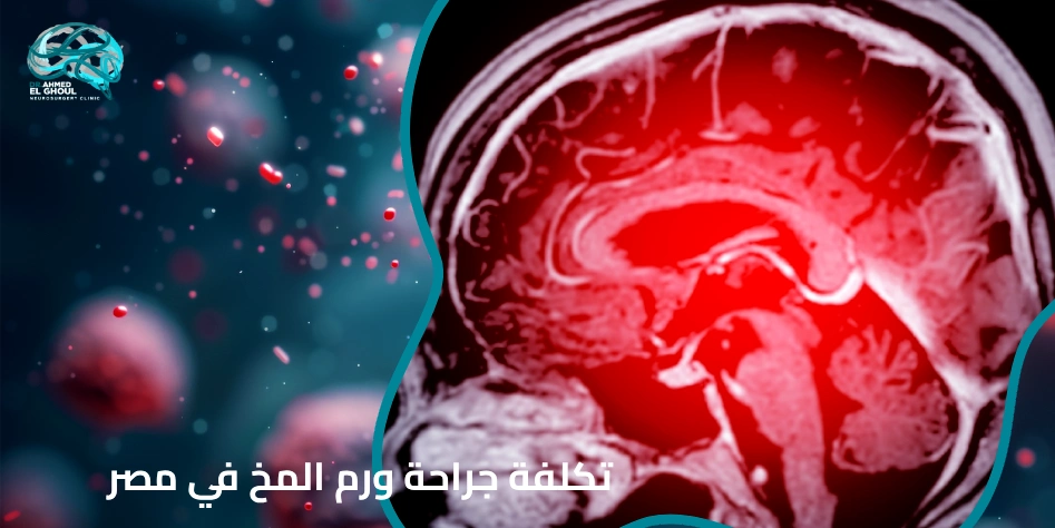 تكلفة جراحة ورم المخ