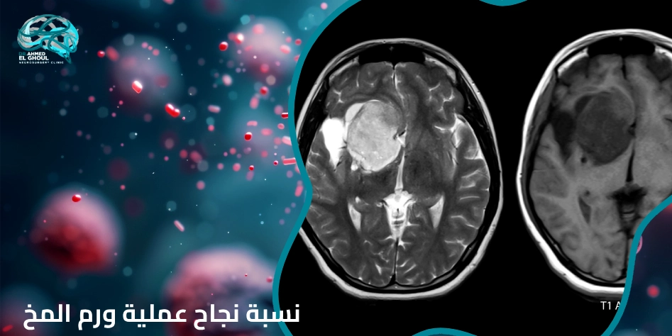 نسبة نجاح عملية ورم المخ