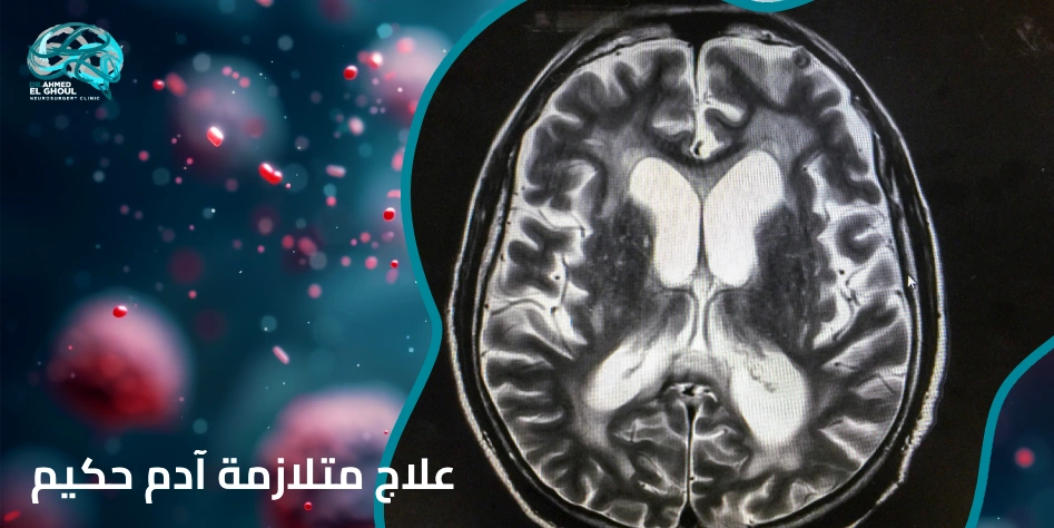 علاج متلازمة آدم حكيم