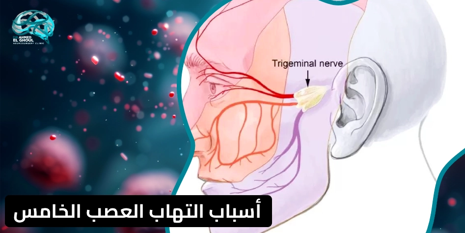 أسباب التهاب العصب الخامس