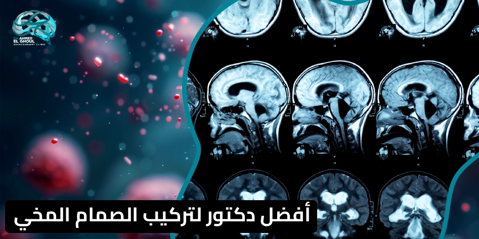 أفضل دكتور لتركيب الصمام المخي