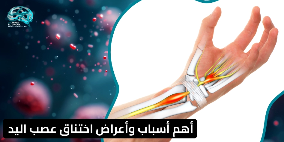 اختناق عصب اليد