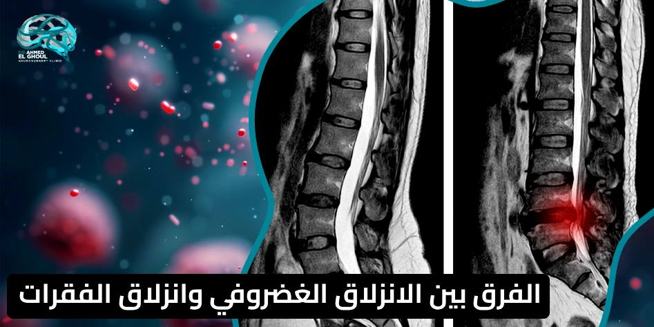 الفرق بين الانزلاق الغضروفي وانزلاق الفقرات
