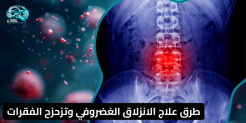 علاج الانزلاق الغضروفي وتزحزح الفقرات