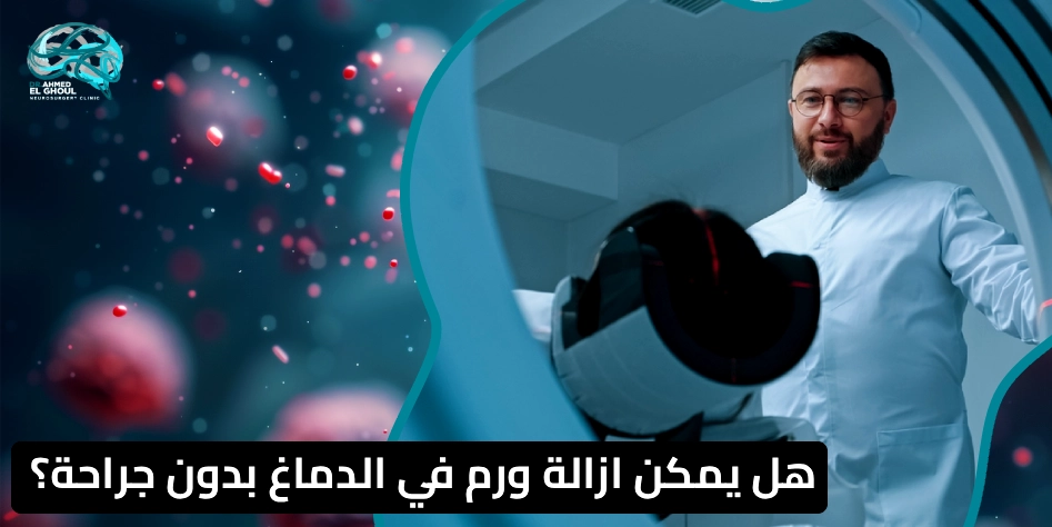 علاج أورام المخ بدون جراحة