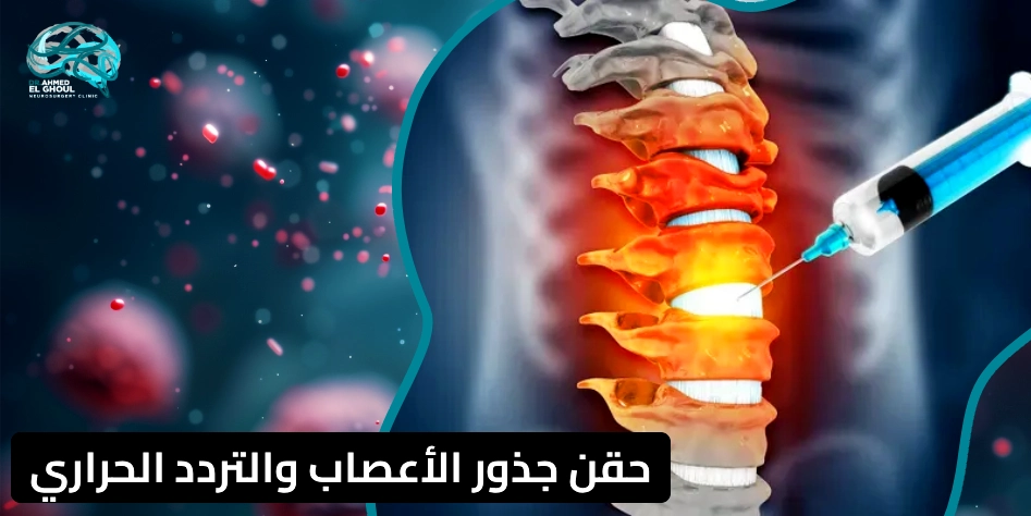 حقن جذور الأعصاب والتردد الحراري