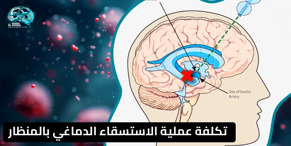 تكلفة عملية الاستسقاء الدماغي بالمنظار في مصر