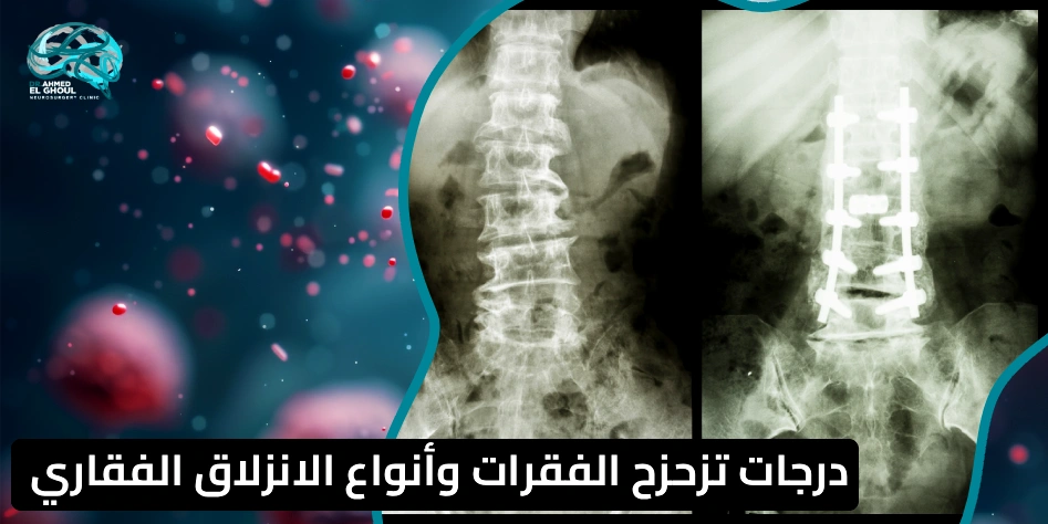 درجات تزحزح الفقرات وأنواع الانزلاق الفقاري