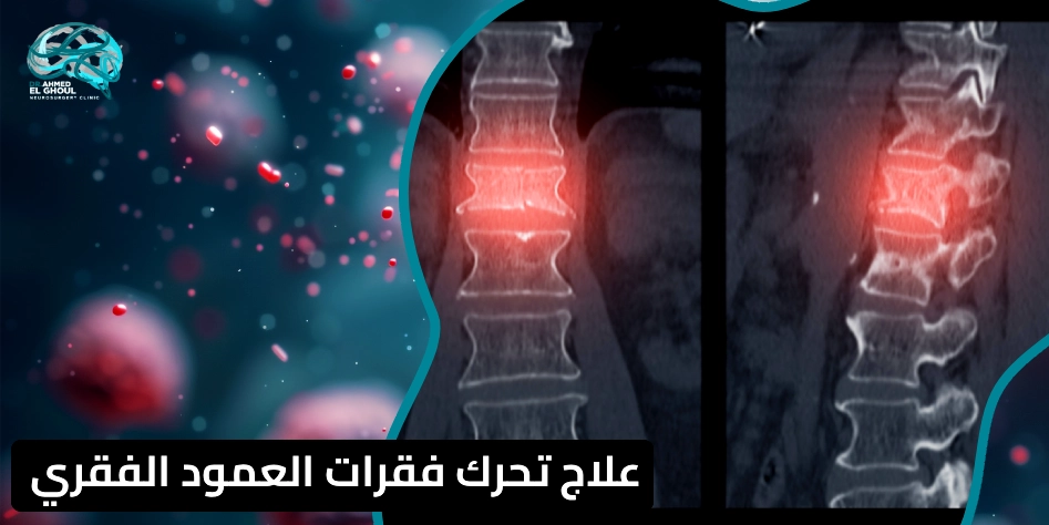 علاج تحرك فقرات العمود الفقري