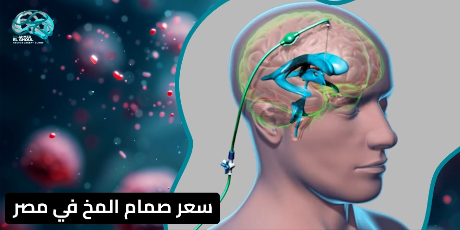 سعر صمام المخ في مصر