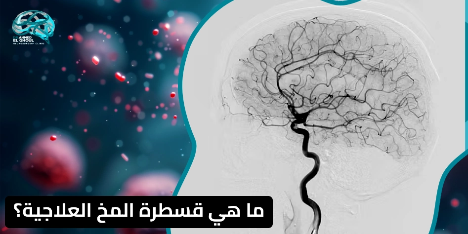 قسطرة المخ العلاجية